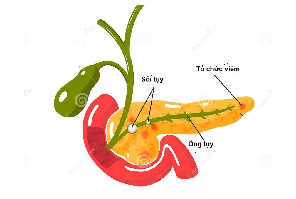 Viêm tụy cấp - bệnh nguy hiểm 